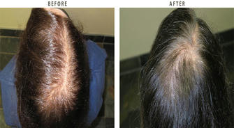 Hair Transplants: A Modern Solution to Hair Loss