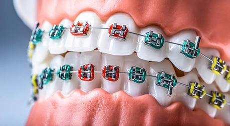 Orthodontics: A Comprehensive Guide to Teeth Alignment and Oral Health