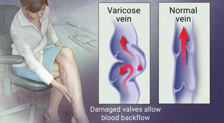 Varicose Veins: Real-Life Stories and Effective Treatments